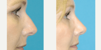 Rhinoplasty (Nose Job) procedure image