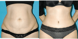 Mommy Makeover procedure image