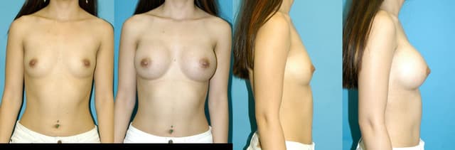 Breast Augmentation procedure image