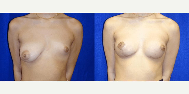 Breast Augmentation procedure image