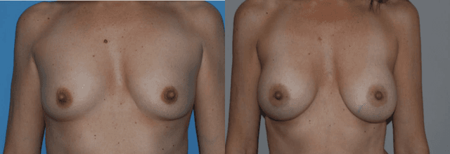 Breast Augmentation procedure image