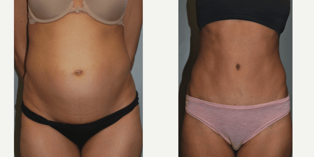 Mommy Makeover procedure image