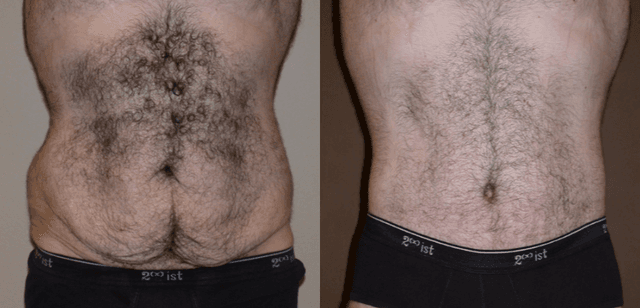 Tummy Tuck (Abdominoplasty) procedure image