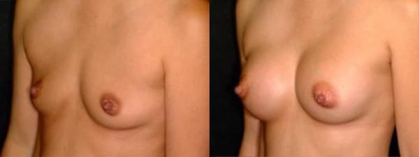 Breast Augmentation procedure image