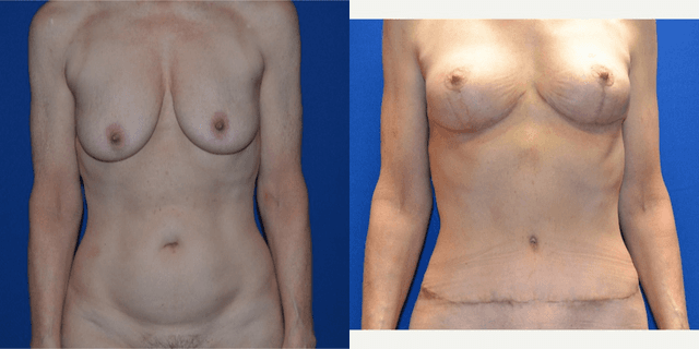 Skin Tightening procedure image