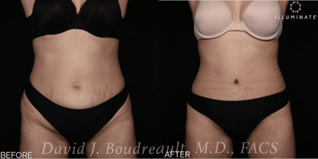Tummy Tuck (Abdominoplasty) procedure image