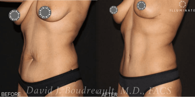 Mommy Makeover procedure image