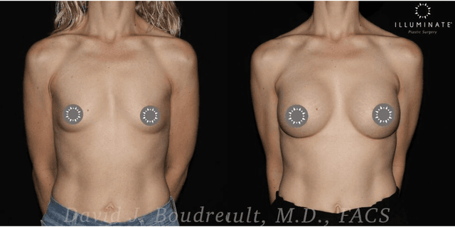 Breast Augmentation procedure image