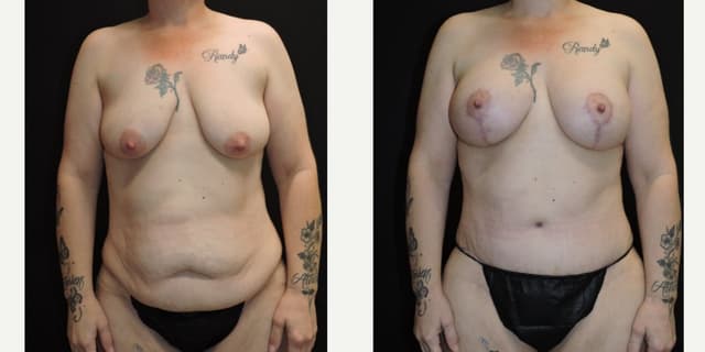 Breast Augmentation procedure image