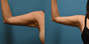 Skin Tightening procedure image