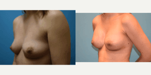 Mommy Makeover procedure image