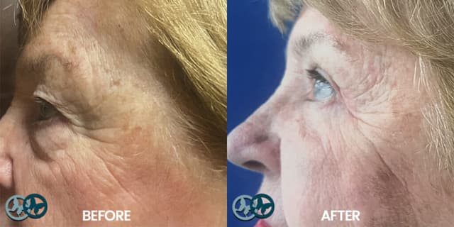Facelift procedure image