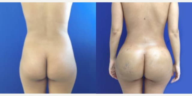 Brazilian Butt Lift (BBL) procedure image