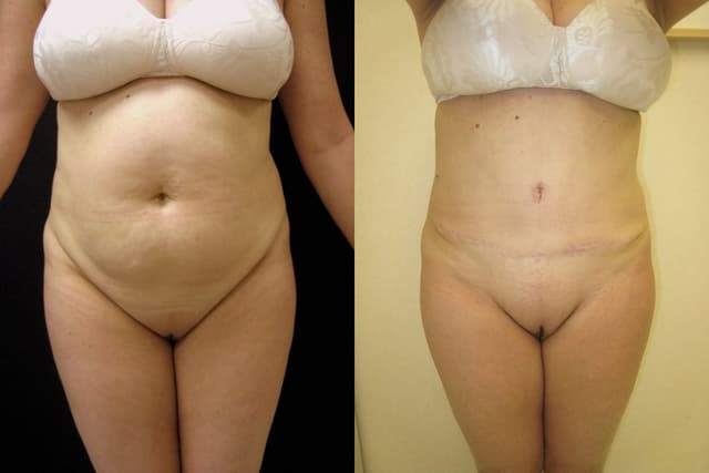 Mommy Makeover procedure image