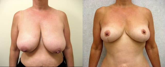 Breast Augmentation procedure image