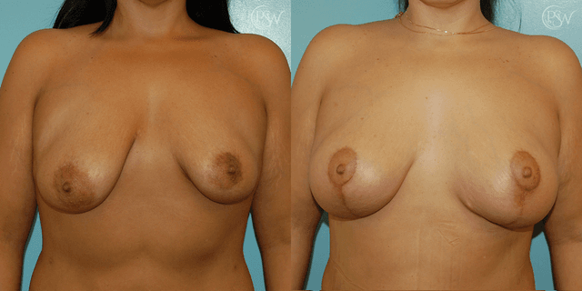 Breast Augmentation procedure image
