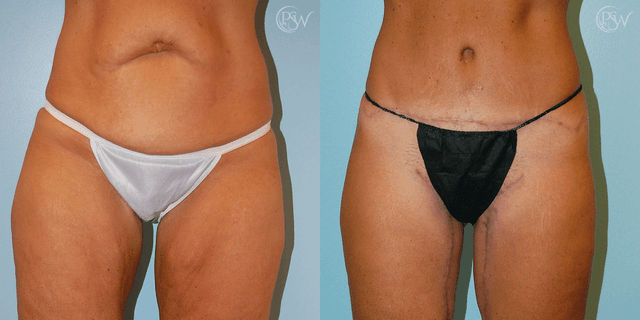 Mommy Makeover procedure image