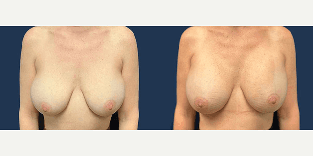 Breast Augmentation with Lift procedure image