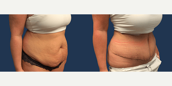 Mommy Makeover procedure image