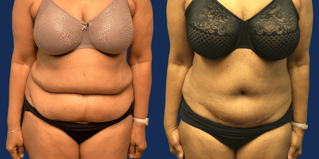 Breast Lift (Mastopexy) procedure image
