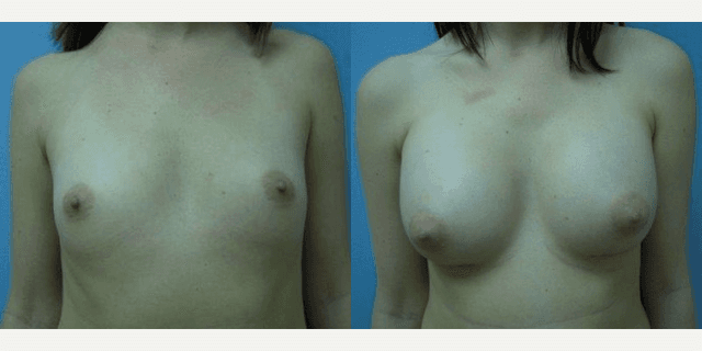 Breast Augmentation procedure image