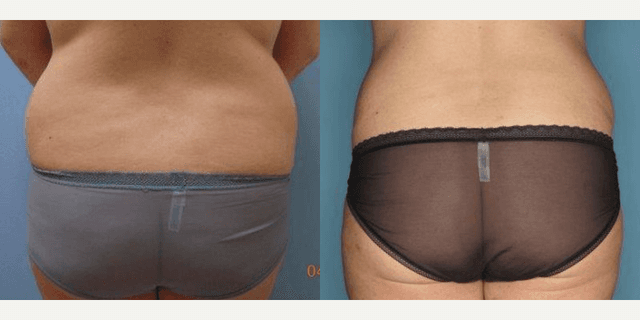 Skin Tightening procedure image