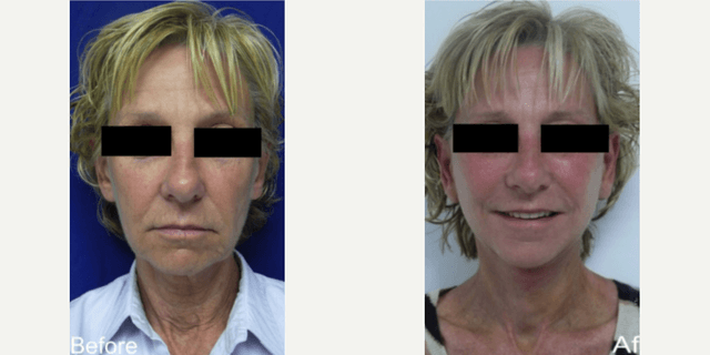 Facelift procedure image
