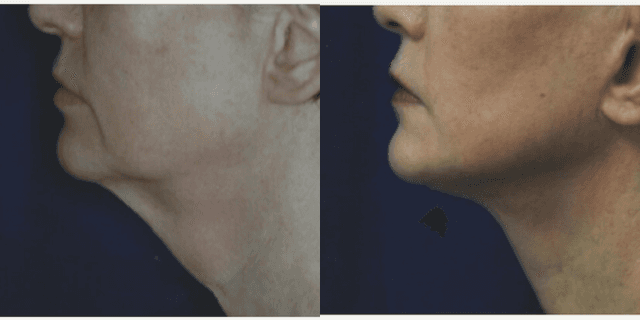 Rhinoplasty (Nose Job) procedure image
