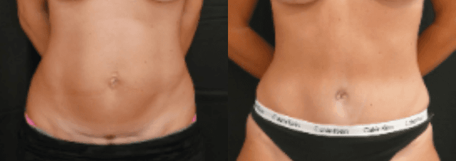 Mommy Makeover procedure image