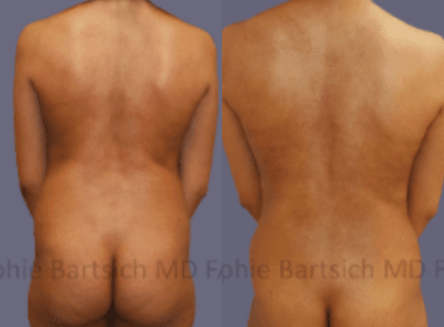 Body Lift procedure image