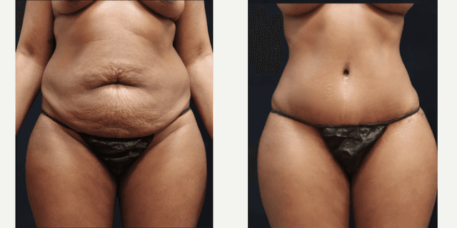 Tummy Tuck (Abdominoplasty) procedure image