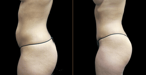 Mommy Makeover procedure image