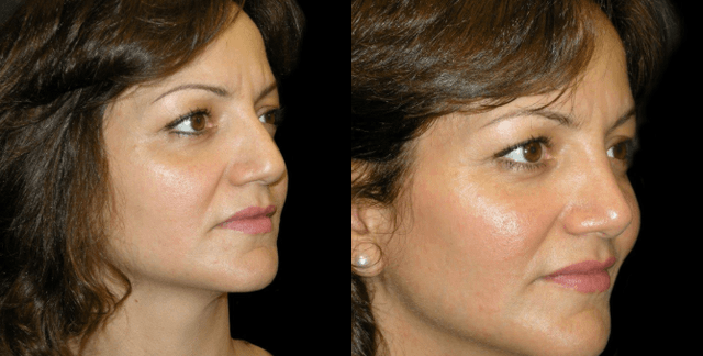 Skin Tightening procedure image