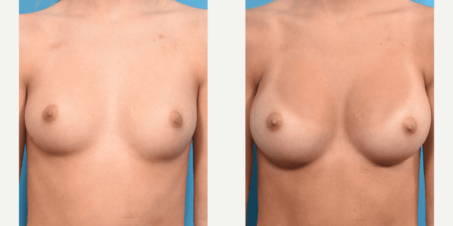 Breast Augmentation procedure image