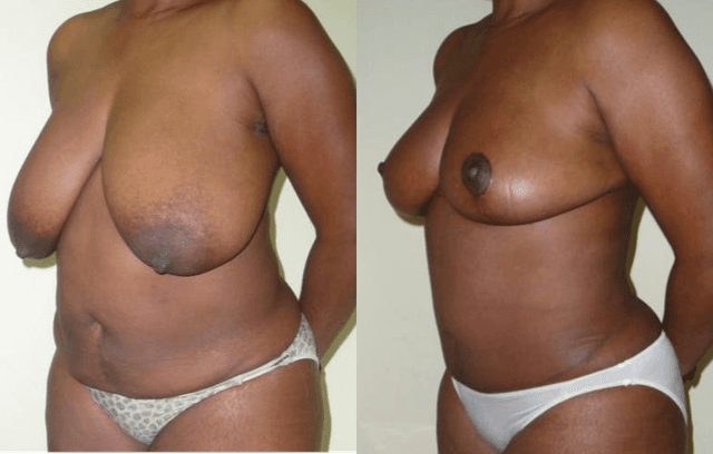 Skin Tightening procedure image