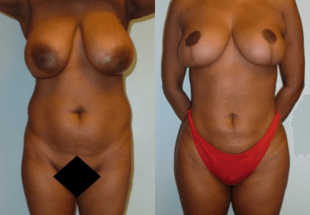 Mommy Makeover procedure image