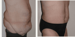 Tummy Tuck (Abdominoplasty) procedure image