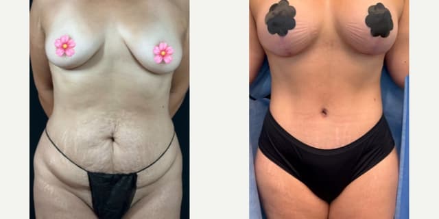 Mommy Makeover procedure image