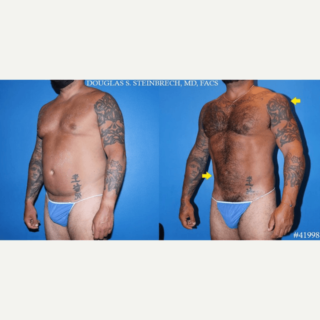 Tummy Tuck (Abdominoplasty) procedure image