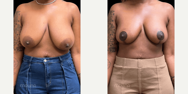Breast Lift (Mastopexy) procedure image