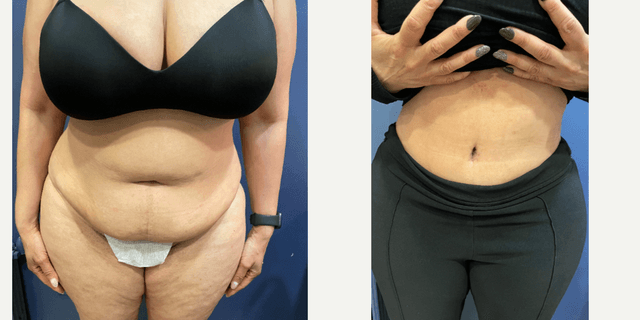 Tummy Tuck (Abdominoplasty) procedure image