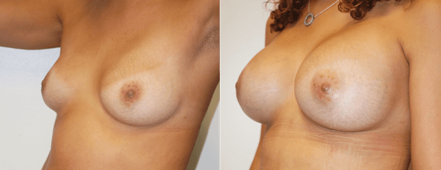 Mommy Makeover procedure image