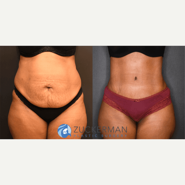 Skin Tightening procedure image