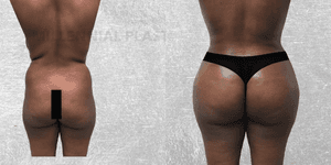 Hip Enhancement procedure image