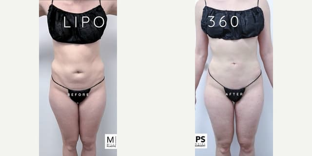 Mommy Makeover procedure image