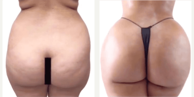 Body Lift procedure image