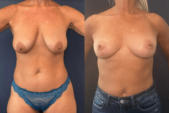 Mommy Makeover procedure image