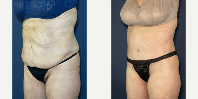Tummy Tuck (Abdominoplasty) procedure image
