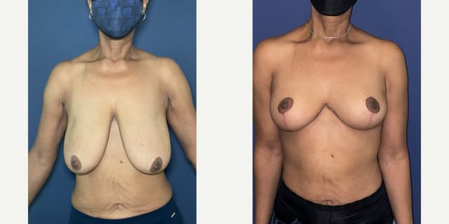 Breast Augmentation procedure image