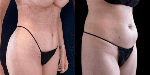 Mommy Makeover procedure image